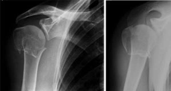 Рентгенография для уточнения характера травмы хирургической шейки плечевой кости